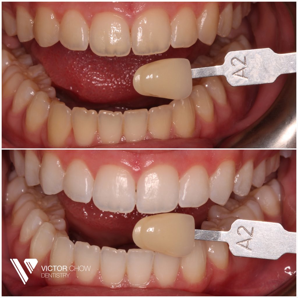 Dr Victor Chow Teeth Whitening