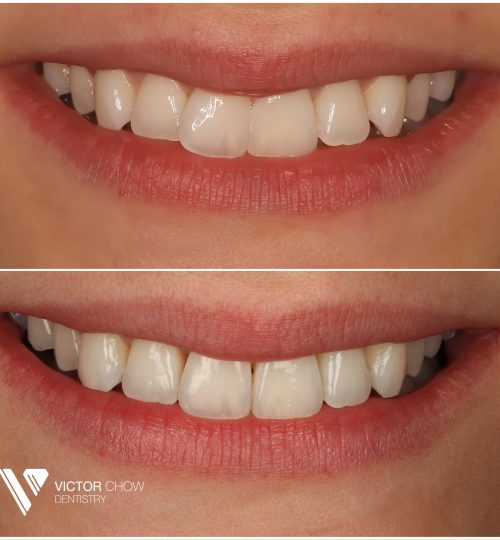 Invisalign teeth straightening