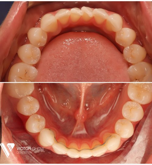 Invisalign teeth straightening