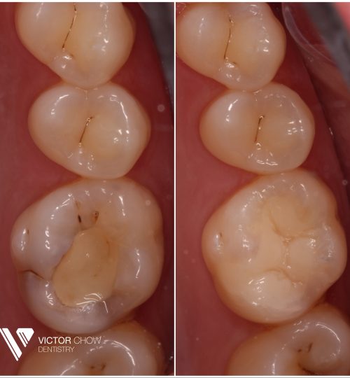 composite bonding