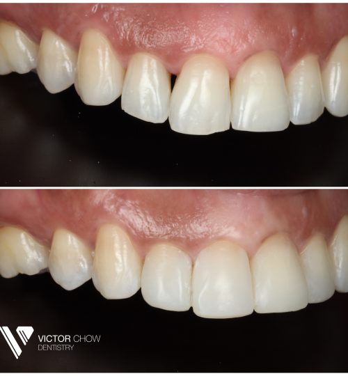 Dr Victor Composite Bonding