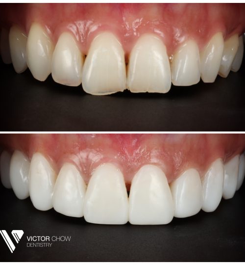 Dr Victor Composite Veneers