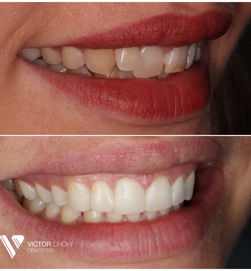 Dr Victor Chow Invisalign