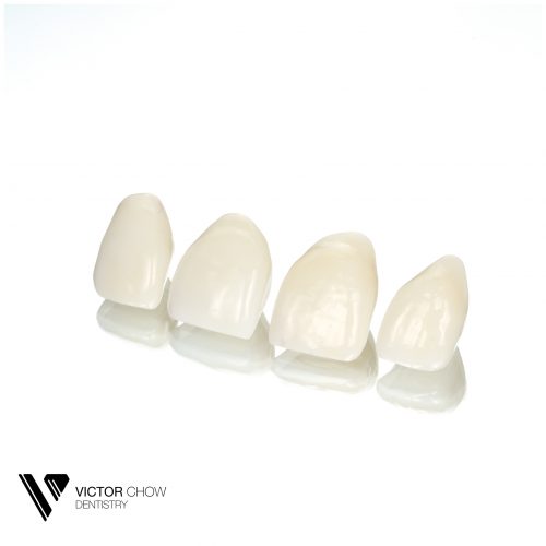 Dr Victor Chow Porcelain Veneer Ceramic Veneer