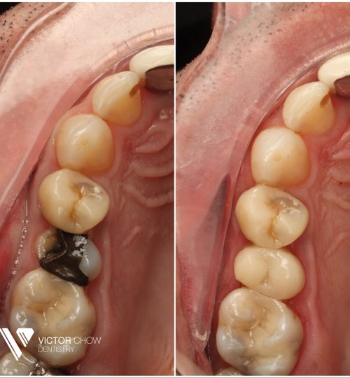 composite bonding