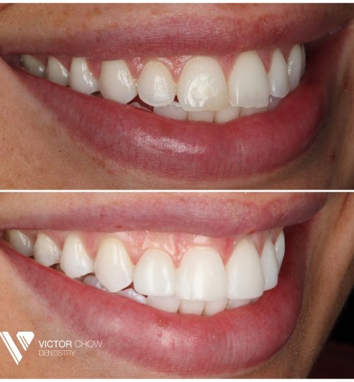 Dr Victor Chow Composite Bonding