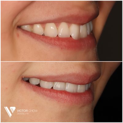 Invisalign composite bonding