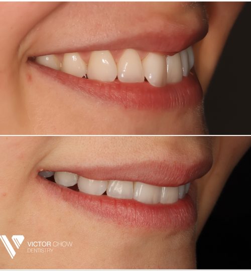 Invisalign composite bonding