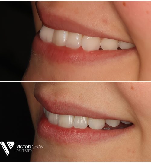 Invisalign composite veneers