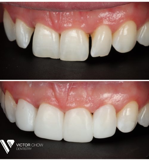 Dr Victor Composite Bonding Composite Veneers