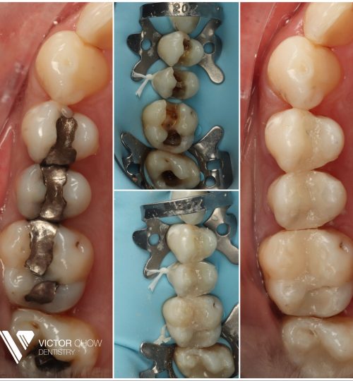 composite bonding