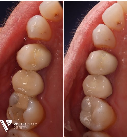 white dental filling